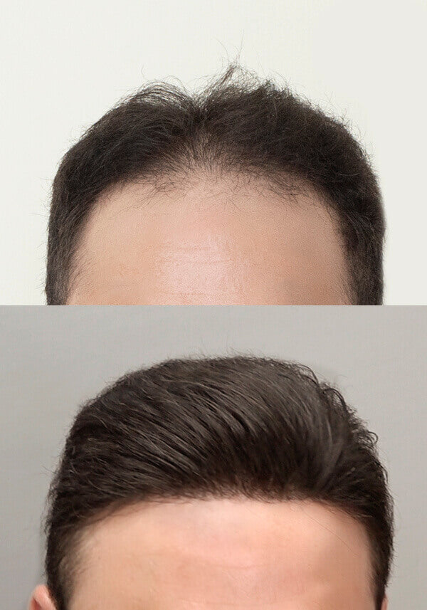 Men's Natural Color Frontal Hairpiece with Super Thin Skin Base